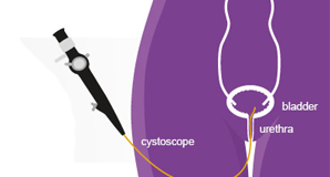 Cystoscopy & Prostrate surgery